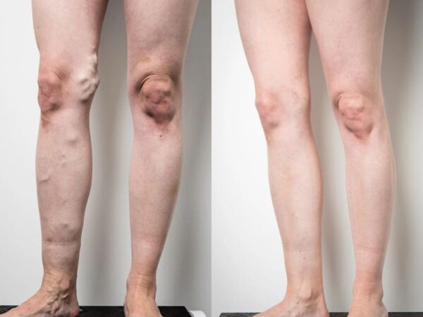 Living Pain-Free: How Vein Treatment Can Help Varicose Veins and Leg Ulcers